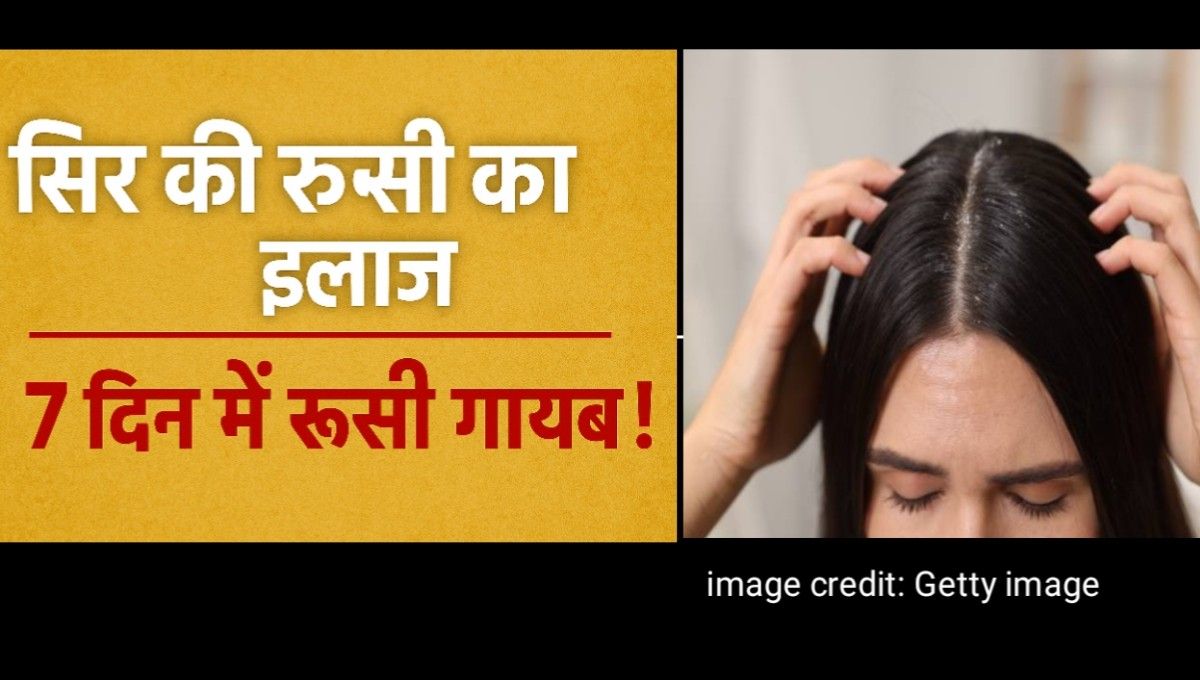 सिर की रूसी का इलाज